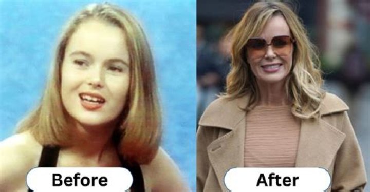 Amanda Holden's rare skin condition that's put her off surgery
